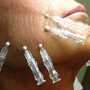 Thread Lift Face, Facial Acupuncture, Pdo Threads, Thread Lift, Botox Fillers, Aesthetic Medicine, Anti Ageing, Lip Fillers, Acupuncture