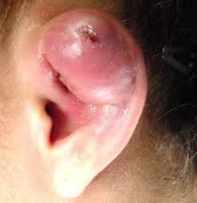 piercing infection - Google Search Infected Cartilage Piercing, Boil Popping Videos, Nose Piercing Infection, Cartilage Piercing Infection, Skin Boil, Ear Pimple, Pimple Popper Tool, Piercing Bump, Graphic Video