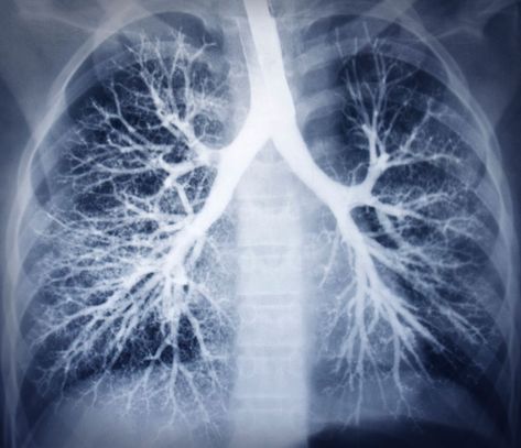 What is COPD? How to build health to help? https://www.mcvitamins.com/copd-lungs.htm #lungs #pulmonary #breathe #airflow Human Respiratory System, Lung Conditions, Healthy Lungs, Chronic Obstructive Pulmonary Disease, Pulmonary Disease, Lung Disease, Respiratory System, Lungs, Respiratory