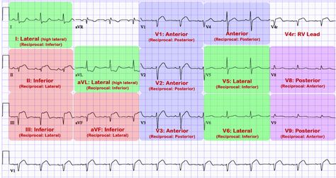 ECG Lead Placement – Cardio Guide Ecg Lead Placement, Lead Placement, Paramedic Student, Cardiology, 3d Visualization, School Resources, Medical School, Nursing School, School Stuff