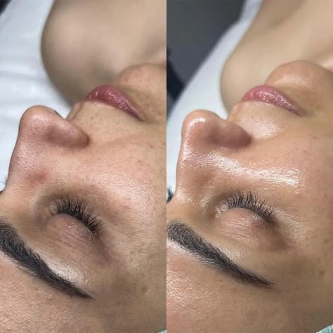 Oxygen Facial Before And After, Before And After Facial Pictures, Facial Care Aesthetic, Facial Aesthetics Skin Care, Facial Before And After, Facial Pictures, Skin Care Pictures, Oxygen Facial, Microcurrent Facial