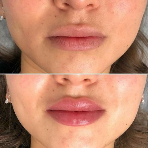 Lip Fillers Juvederm, Dermal Fillers Lips, Juvederm Lips, Lip Permanent Makeup, Lips Fillers, Lips Inspiration, Lips Shape, Permanente Make-up, Botox Lips