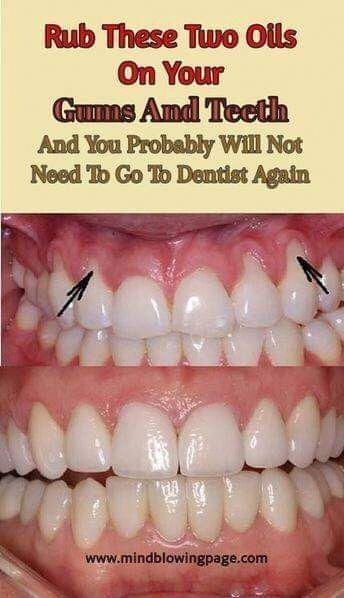 10 easy ways to treat receding gums naturally! #FitLife #FitnessTips #HealthyLiving #SelfCare #NutritionTips #HealthTips #HealthyLifestyle #Wellness Dental Hacks, Healing Tea Recipes, Toddler Tooth Decay, Teeth Remedies, Tooth Decay Remedies, Beauty Treatments Skin Care, Teeth Whitening Homemade, Homemade Toothpaste, Healing Tips