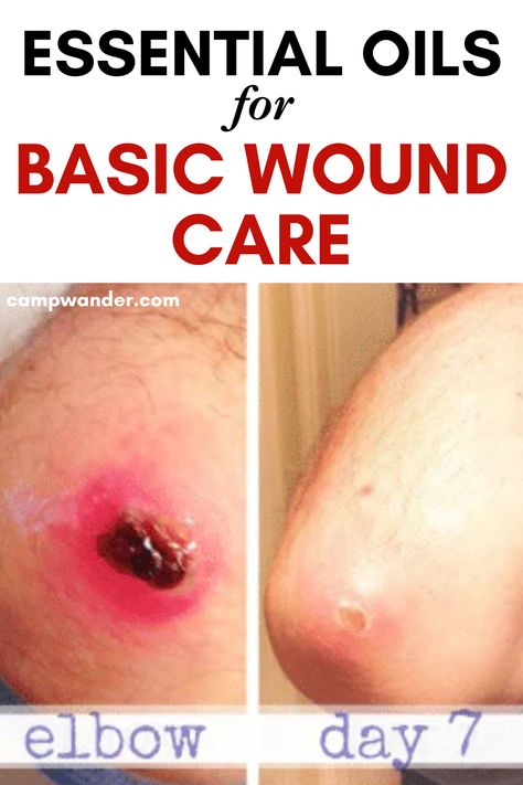 a healing wound before and after with text overlay essential oils for basic wound care Essential Oils To Heal Skin Wounds, Essential Oil For Open Wound, Essential Oils For Infection, Wound Healing Remedies, Essential Oils For Wound Healing, Wound Care Healing, Scab Healing, Antifungal Essential Oil, Antiviral Essential Oils