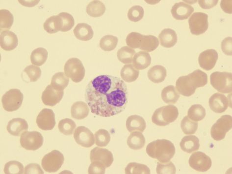 There are several different types of Myelodysplastic Syndrome, but all involve the inability of bone marrow to produce enough healthy blood cells. Myelodysplastic Syndrome, Low Platelets, Abnormal Cells, Stressful Job, White Blood Cells, Bone Marrow, Bacterial Infection, Red Blood Cells, Shortness Of Breath