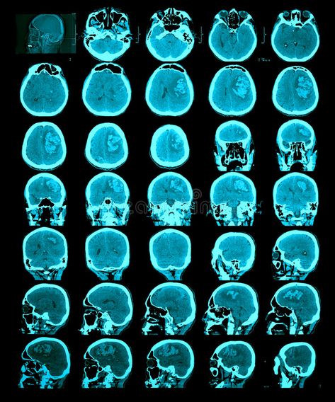 CT scan of the brain. Hemorrhagic stroke. Information for professionals royalty free stock photos Brain Scan Neuroscience, Ct Scan Brain, Psychology Posters, Bruce Nauman, Igcse Art, Brain Parts, Brain Images, Brain Scan, Medical Photos