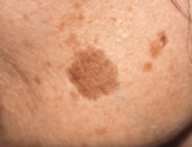 Simple Trick to Remove Brown Spots from Your Skin | TipHero Skin Spot Remover, Age Spots On Face, Brown Age Spots, Age Spot Removal, Brown Spots On Skin, Brown Spots Removal, Brown Spots On Face, Skin Spots, Spots On Face