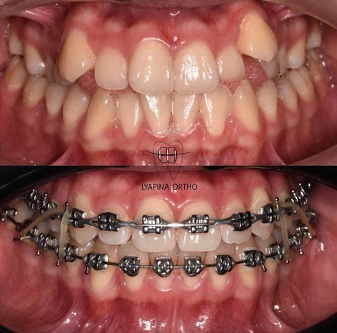 Teeth Braces Before And After, Teeth After Braces, Braces Before And After, Dental Animation, After Braces, Dental Wallpaper, Dream Face, Dental Photos, Adult Braces