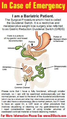 Duodenal Switch Surgery, Duodenal Switch Diet, Duodenal Switch Recipes, Bariatric Tips, Gastric Surgery, Duodenal Switch, Bariatric Meals, Bariatric Sleeve, Success Advice