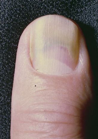 Green Nail Syndrome (GNS, Pseudomonas nail infection, chloronychia, green striped nails, chromonychia) - Dermatology Advisor Green Nail Syndrome, Nail Disorders, Fingernail Fungus, Pseudomonas Aeruginosa, Green Acrylic Nails, Nail Infection, Brittle Nails, Green Nail, Black Pigment