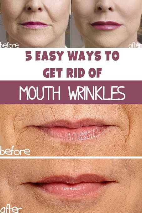 Wrinkle Remedies Face, Sun Spots On Skin, Mouth Wrinkles, Brown Spots On Skin, Wrinkle Remedies, Dark Spots On Face, How To Grow Eyebrows, Brown Spots On Face, Skin Spots