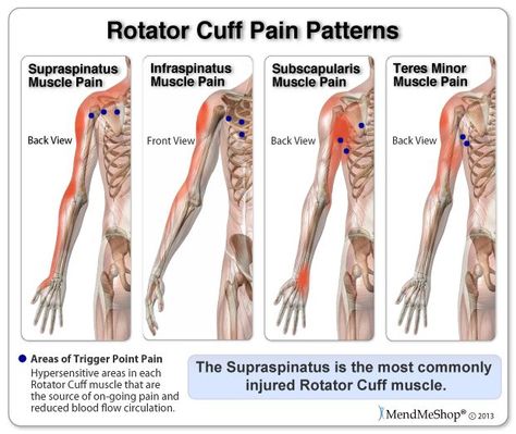 Even after initial pain is reduced trigger points in the rotator ... Rotator Cuff Pain, Shoulder Rehab, Rotator Cuff Tear, Rotator Cuff Injury, Soft Tissue Injury, Trigger Point Therapy, Frozen Shoulder, Shoulder Injuries, Rotator Cuff