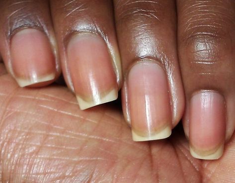 Amazing Home Remedies for Nail Discoloration - NAILCON Stained Nails, Nail Discoloration, Nail Infection, Proper Hygiene, Fungal Nail, Nails Today, Antibacterial Soap, Nail Care Routine, Toenail Fungus