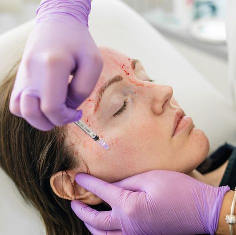 Vampire Facials Have Been Linked To 2 Cases Of HIV At A Spa In New Mexico Vampire Facial, Skin Needling, Platelet Rich Plasma, Facial Aesthetics, Aesthetic Medicine, Facial Rejuvenation, Aesthetic Clinic, Collagen Supplements, Cosmetic Procedures