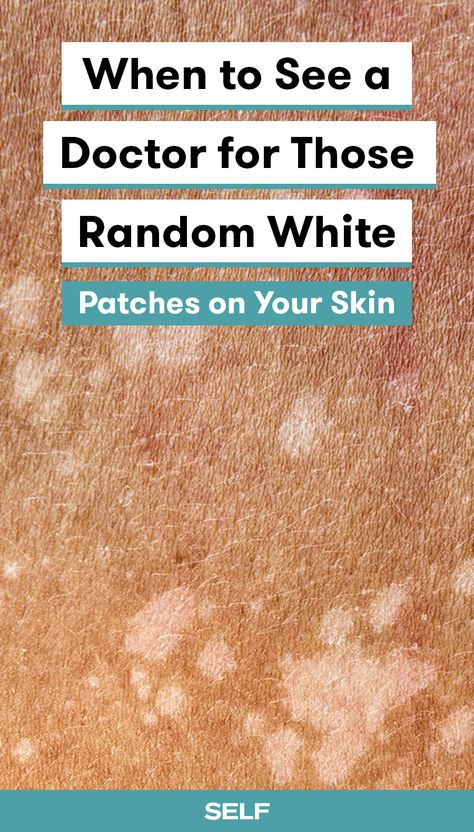 White Skin Patches, White Skin Spots, Pigmentation Remedy, Dark Patches On Skin, Dry Skin Patches, Skin Spots, White Patches, Skin Disorders, Skin Diseases