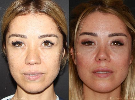 Nose Exercise Before And After, How To Fix Your Nose Without Surgery, Nose Tip Lift, Tip Plasty, Celebrity Nose Jobs Before After, Tip Plasty Nose, Fat Transfer, Chelsea London, Stem Cells