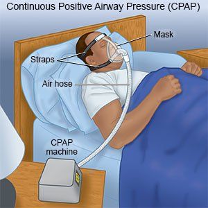 Discover how a CPAP machine can transform your sleep quality, alleviate snoring, and enhance overall health. Experience the benefits of a CPAP machine today! - #bettermood #betteroxygenation #continuouspositiveairwaypressure #CPAPtherapy #decreaseddaytimesleepiness #decreasedinflammation #decreasedriskofstroke #enhancedoverallhealth #improvedbloodpressurecontrol #improvedcognitivefunction... Therapy Benefits, Daytime Sleepiness, Sleep Therapy, Cpap Machine, Respiratory Care, Feeling Fatigued, Breathing Problems, Improve Cognitive Function, Sleep Health