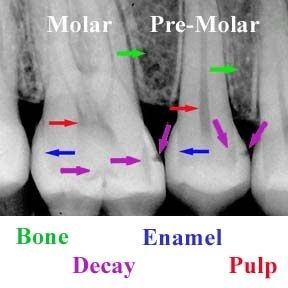 How to read a dental x-ray How To Read Dental Xrays, Tooth Xray, Dental Xrays, Dental Radiology, Dental Assistant School, Hygiene School, Dental Assistant Study, Dental Education, Dentist Teeth