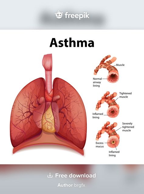 Throbbing Headache, How To Help Nausea, Severe Asthma, Healthy Lungs, Chronic Obstructive Pulmonary Disease, Asthma Symptoms, Pulmonary Disease, Healthy Morning Routine, Respiratory Diseases