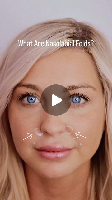 Niki Lister on Instagram: "Nasolabial folds are those lines that run from your nose to the corners of your mouth. 

They’re a natural part of aging, but factors like sun damage, smoking, and genetics can make them more prominent.

So, what can be done about them? A combination of Botox and dermal filler can be used to soften the lines.

Botox helps relax the muscles that contribute to the deepening of these lines, while dermal filler adds volume to the area, smoothing out the folds.

Want to learn more about how I can help you achieve your skincare goals? Send me a DM or click the link in my bio.

#nasolabial #nasolabialfolds #nasolabialfoldfiller #nasolabialfiller #nasolabialfold #417sgf #botoxtips" Nasolabial Fold Filler, Skincare Goals, Facial Fillers, Nasolabial Folds, Dermal Fillers, Sun Damage, Click The Link, Muscles, Facial