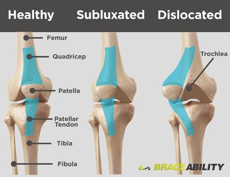 Are you suffering from patellar (kneecap) instability? Protect yourself from patellar subluxation and dislocation by first understanding the difference. Patellar subluxation is just a partial kneecap dislocation. Whereas, patellar dislocation refers to a fully dislocated kneecap. Click this image to learn more about kneecap subluxation and dislocation! Patellar Tracking Disorder, Knee Dislocation, Knee Injury Recovery, Bursitis Knee, Manual Muscle Testing, Patellofemoral Pain Syndrome, My Knee Hurts, Swollen Knee, Muscle Testing