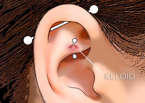 Keloid or Piercing Bump? Piercing Bump Remedy, Piercing Bump, Clear Skin Routine, Just Let Go, Blackheads On Nose, Teen Skincare, Face Care Routine, Skin Patches, Luxury Cosmetics