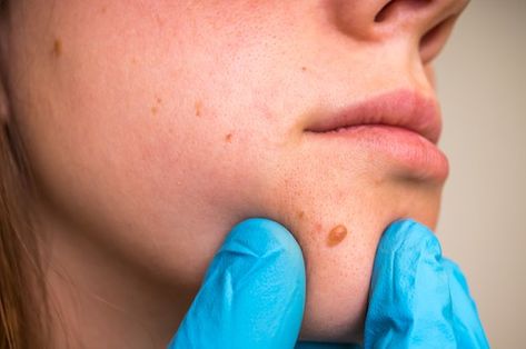 The Complete Guide to Basal Cell Carcinoma What Are Skin Tags, Remove Skin Tags, Remove Skin Tags Naturally, Basal Cell, Health Articles Wellness, Mole Removal, Skin Tags, Homemade Facials, Natural Cream