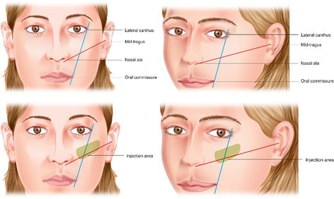 Fig. 5. Patient with Hinderer lines drawn and the area marked out in the midface for injectable filler. - "Midface injectable fillers: have they replaced midface surgery?" Endoscopic Brow Lift, Face Fillers, Hyaluronic Acid Fillers, Tear Trough, Cheek Fillers, Facial Fillers, Cosmetic Injectables, Facial Plastic Surgery, Injectables Fillers