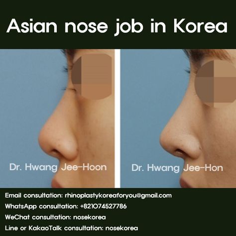 Asian people commonly has flat, wide and big nose.  It is a traditional nasal shape, however, as time goes, many of Asian began to like higher and sharp nose.  Because, as many people getting use Instagram, face-book and YouTube, they started to want to have better facial profile at their photos and videos.  When has higher nose, facial line become more dimensional profile  #asiannosejob #aisan_nose_job #nosejob #nose_job_korea #asian_rhinoplasty #asianrhinoplasty #rhinoplasty #rhinoplastykorea Asian Nose Job, Korean Nose Job, South Korean Plastic Surgery, Tip Plasty, Asian Nose, Nose Rhinoplasty, South Korea Beauty, Ethnic Rhinoplasty, Korean Plastic Surgery