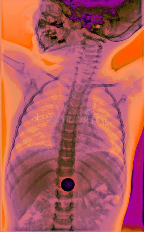 Color X-ray Art, Child 1. This is a colorized x-ray of a child who swallowed mon , #sponsored, #colorized, #swallowed, #child, #ray, #Color #ad Brain Xray, X Ray Aesthetic, X Ray Art, Projector Background, Evil Flower, Medicine Art, Baby Technology, Xray Art, Disco Elysium