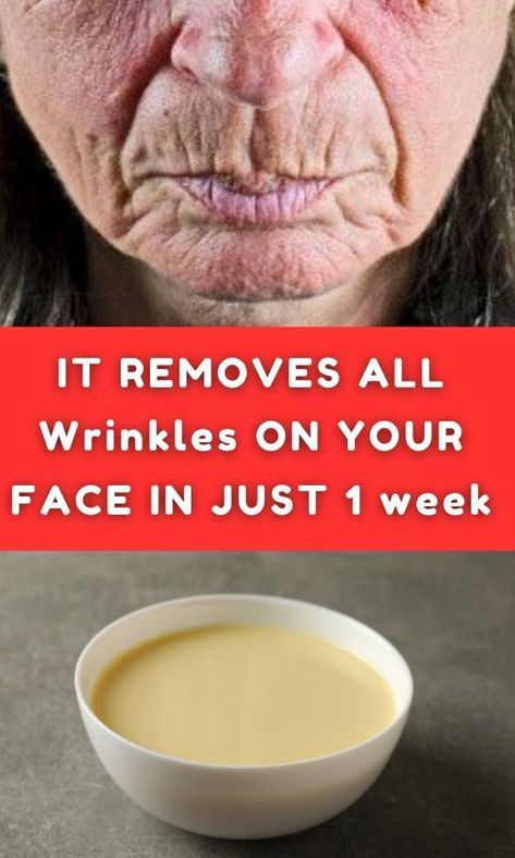 Forever young Korean secrets - Use this mask to help you get rid of wrinkles and get younger skin soon. Click right on the image to view now Home Remedies For Wrinkles, Homemade Wrinkle Cream, Wrinkle Remedies, Wrinkle Free Skin, Erase Wrinkles, Under Eye Wrinkles, Skin Care Wrinkles, Face Wrinkles, Deep Wrinkles