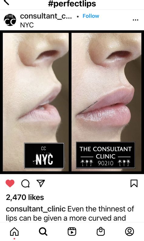 Angelic Lip Filler, Lip Filler Downturned Lips, Flat Lips Filler, Lip Flip Before And After, 0.5ml Lip Filler Before And After, Lip Filler Inspiration, 1ml Lip Filler, Face Plastic Surgery, Lip Flip