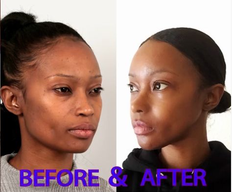 Click to read her story. She had Forehead reduction, Rhinoplasty, V-line surgery, Cheekbone reduction and Fat graft in ID Hospital.  #idhospital #cheekbonereduction #fatgraft #mommymakeover #vline #vlinesurgery #rhinoplasty #plasticsurgerinkorea #plasticsurgerybeforeafter #koreanplasticsurgery #antiaging #transformation #transformationpicture Face Contouring Surgery, Reduction Rhinoplasty, Perfect Forehead, Cheekbone Reduction, Forehead Reduction, Ethnic Rhinoplasty, V Line Surgery, V Line Face, Korean Plastic Surgery