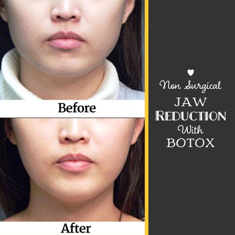 Botox Jaw, Square Jaw, Square Jawline, Wide Jaw, Jaw Line, Facial Rejuvenation, Santa Clarita, Dermal Fillers, After Photos