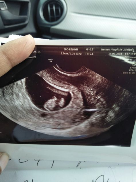 12weeks 5days scan no heart beat..! Stopped at 8weeks!💔 Scan Photos, Baby Scan Photos, Baby Scan, Ct Scan, Body Scanning, Black Person, Human Heart, Heart Beat, In A Heartbeat