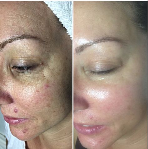 Here we see the stunning results from receiving a VI Peel! Talk about an incredible transformation! Diy Chemical Peel, Peeling Facial, Acne Scarring, Natural Skin Care Remedies, Acne Skincare, Acne Scar Removal, Scarring, Peeling Skin, Acne Remedies