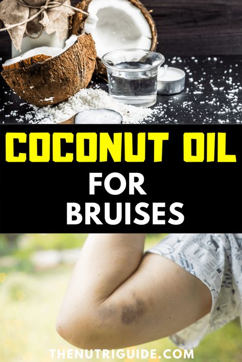 Coconut Oil For Bruises: Treat Your Bruise Naturally- Get rid of bruises naturally and fast #bruise #coconut #coconutoil #superfoods Superfood Benefits, Reduce Bruising, Living Oils Recipes, Herbal Medicine Recipes, Essential Oil Carrier Oils, Essential Oil Remedy, Oil Remedies, Reduce Swelling, Body Healing