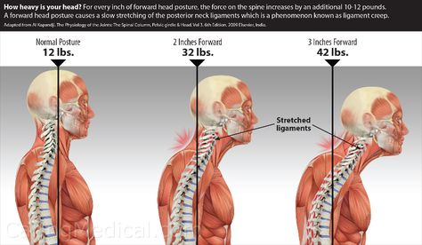 Cervical Lordosis, Cervical Instability, Neck Headache, Swallowing Problems, Lumbar Lordosis, Text Neck, Venous Insufficiency, Cervical Spine, Muscle Spasms