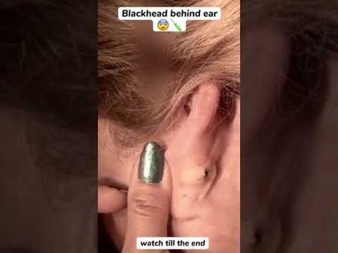 Blackhead Behind Ear #oddlysatisfying #sick #blackhead #pimplepopper #satisfying #cyst #wow #acne Blackheads Removal Cream, Ear Pimple, Big Pimple, Cystic Pimple, Cystic Acne Remedies, Dilated Pores, Blackhead Remover Diy, How To Pop Ears, Zits Popping