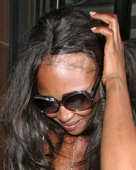 PICS of black women with 20" hair weave | 10 TIPS TO GROW BACK HEALTHY NATURAL HAIRLINE | Worldofbraiding Blog Damaged Black Hair, Naomi Campbell Hair, Bad Hairline, Thinning Edges, Hair Fixing, Regrow Hair, Hair Affair, Hair Remedies, Natural Hair Tips