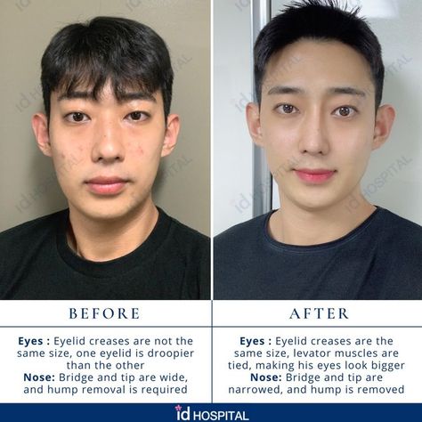 This Korean male patient wanted to get plastic surgeries at ID Hospital, to have a more defined nose and bigger eyes with even eyelid creases.
Surgeries he had:
🌠 Rhinoplasty with osteotomy and hump reduction
🌠 Incision Ptosis Correction
#idhospitalkorea #koreanplasticsurgery #plasticsurgery #plasticsurgerykorea #seoul #korea #rhinoplasty #rhinoplastybeforeandafter #asianrhinoplasty #nosejob #nosejobbeforeandafter #maleplasticsurgery #plasticsurgeryformen #IDtransformation #IDbeforeandafter Defined Nose, Plastic Surgery Korea, Korean Plastic Surgery, Bigger Eyes, Rhinoplasty Before And After, Nose Job, Seoul Korea, Plastic Surgery, Seoul