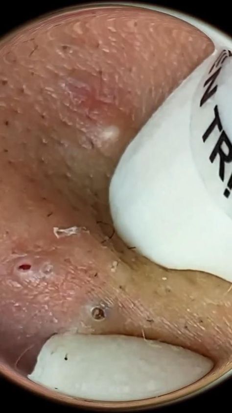 Watch satisfying #pimplepopping & #blackheadremoval videos that are guaranteed to make you cringe and say "ew!" #gross #popping #satisfying Blackheads Removal Satisfying Videos, Satisfying Black Head Removal Video, Black Head Removal Video Nose, Huge Blackheads, How To Treat Blackheads, Diy Pore Strips, Best Dark Spot Remover, Satisfying Zit Popping Videos, Kelly Hair