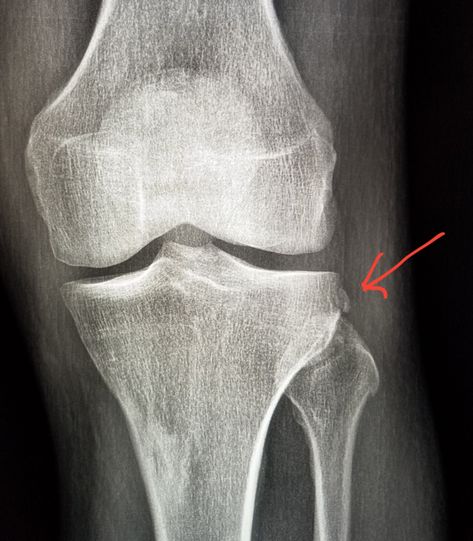 #Knee #Xray shows a #fracture (#segond) which suggests an #ACL tear.  #radiology #radiologist #pain #injury #trauma Acl Injury X Ray, Knee Xray, Hospital Admit, Hospital Admit Hand Pics, Acl Tear, Radiology, X Ray, Anime, Quick Saves