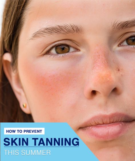 Unprotected sun exposure may give you premature ageing, freckles, and dark spots etc.  So, to save yourself from some trouble, follow these summer hair care tips   #suntan #tanning #summer  #skincare   #suntanning  #suntanned #suntanremoval Sun Tan Removal, Sun Allergy, Summer Hair Care, Summer Skincare, After Sun, Enjoy Summer, Sun Exposure, Tan Skin, Summer Hair