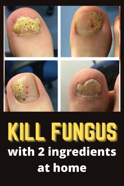 Ignoring toenail fungus might lead to: Foot pain — Spread to the surrounding skin on the foot — Cause widespread infection Story of one Infected Toenail fungus; Why my firefighter dad nearly died… Toenail Health, Toenail Fungal Infection, Nail Remedies, Cuadros Diy, 2 Ingredient Recipes, Toenail Fungus Remedies, Fungal Nail, Toenail Fungus, Fungal Infection