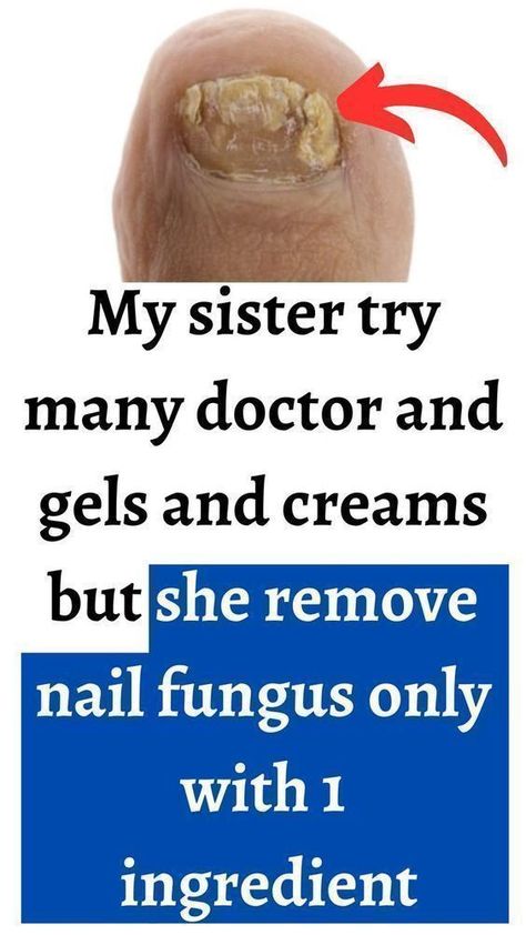 Toe Nail Fungal Infection Vinegar Tea, Fungal Infection Remedies, Infected Toenail, Toenail Health, Toenail Fungal Infection, Nail Remedies, Fingernail Fungus, Toenail Fungus Remedies, Nails Healthy