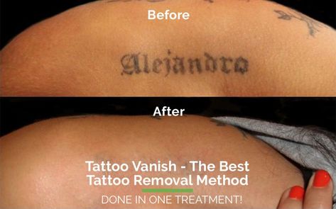 The Tattoo Vanish® Method - Learn Why No Other Tattoo Removal Method Compares | Tattoo Removal Without Laser (Laserless) | Painless Non-Laser Tattoo Removal Near Me | Tattoo Vanish At Home Tattoo Removal, Doe Tattoo, Tattoo Removal Cream, Painless Tattoo, Desktop Background Pictures, Latest Tattoos, About Tattoo, Laser Tattoo, Laser Tattoo Removal