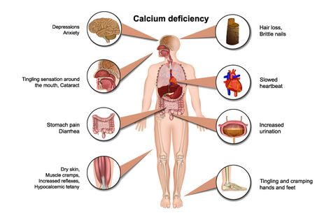 Calcium Deficiency Symptoms, Deficiency Diseases, Deficiency Symptoms, Calcium Deficiency, Good Sources Of Calcium, Calcium Rich Foods, Vitamin D Supplement, Calcium Supplements, Women Health Care