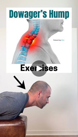 3.3K views · 91 reactions | 🚨 SAY GOODBYE TO DOWAGER'S HUMP!   Are you struggling with a hump where your neck meets your upper back?  This common issue, known as Dowager's Hump, occurs when your spine loses its healthy curve and rounds into a C-shape, putting pressure on the neck and moving the head forward. Often resulting from poor posture and aging, it can limit neck mobility and impact your appearance, even if it doesn’t always cause discomfort.  🚨 Don't let Dowager's Hump impact your posture and comfort! It’s more than just a cosmetic concern—it can lead to neck pain and misalignment.  Take action today! Just a few minutes of daily exercises can make a world of difference.  Try these targeted exercises to strengthen and align the muscles, helping to reduce that hump and enhance your Exercise To Reduce Neck Hump, How To Remove Back Neck Hump, Fix Dowagers Hump, Stretches To Fix Neck Hump, How To Fix Posture Neck Hump, Back Hump, Dowager Hump, Healthy Curves, Dowager's Hump