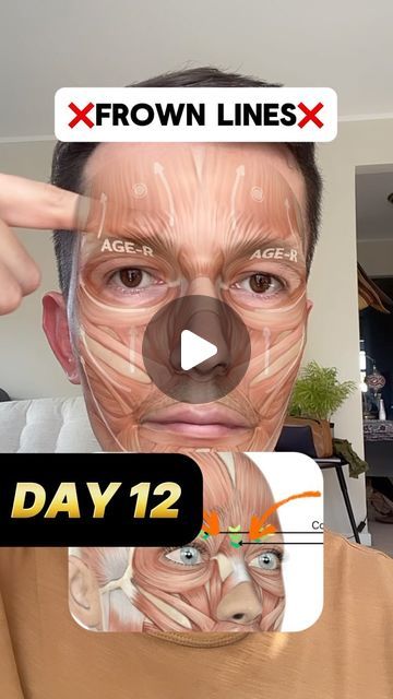 Revimas | Self-massage mobile app on Instagram: "✅more like this: @revimasapp

✨ Welcome to Day 12/30 of our Self-Massage Challenge!✨

Smooth Away Frown Lines with This Quick Massage ✨

Struggling with stubborn frown lines? This easy self-massage targets the muscles that cause 11s/ frown lines, helping to release tension and soften the skin. By taking a few minutes to care for your face, you’re not only relaxing the muscles but also letting go of stored emotional stress. Everything is connected!

Pair this routine with a good moisturizer, and stay consistent for the best results. You’ll start seeing a smoother, refreshed look in no time!

You can find the oil that I use in the link at the top of my profile if you’re interested.

💡Tip: Use your favorite moisturizer or serum for even better Fire Honey, Good Moisturizer, Morning Yoga Stretches, Frown Lines, Release Tension, Everything Is Connected, Stay Consistent, Self Massage, Facial Exercises